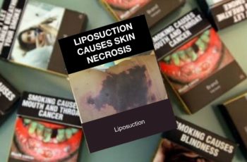 Liposuction – Do You Consent?